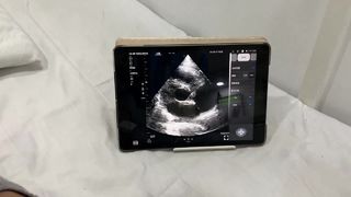 हृदय और POCUS के लिए डुअल हेड वायरलेस अल्ट्रासाउंड जांच